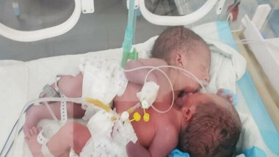 "من أجل توأم سيامي".. ميليشيا الحوثيين تناشد الأمم المتحدة