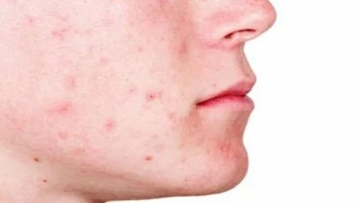 تفسير حلم الحبوب في الوجه: دلالات الجمال والتحديات