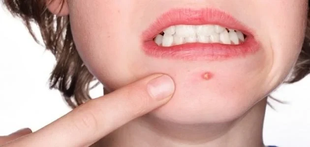 تفسير حلم الحبوب في الوجه